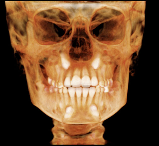 CBCT scanner